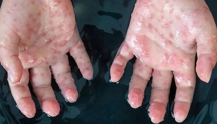 علامت ویژه آبله میمونی بزرگ شدن غدد لنفاوی است