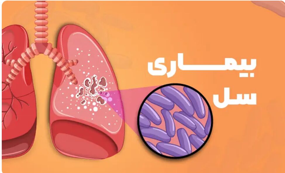همه‌چیز درباره «سل»؛ از عواملی که باعث ابتلا می‌شوند تا راه اصلی پیشگیری از مبتلا شدن
