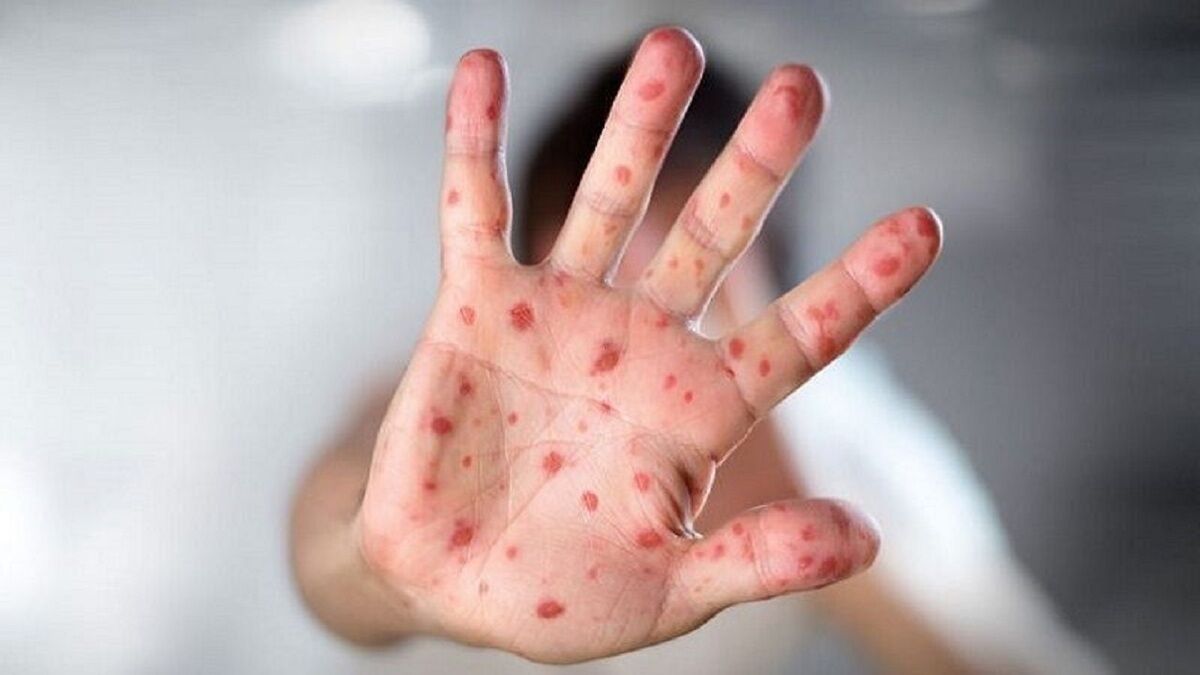 موارد ابتلا به سرخک در آمریکا به حدود ۹۰۰ تن رسید