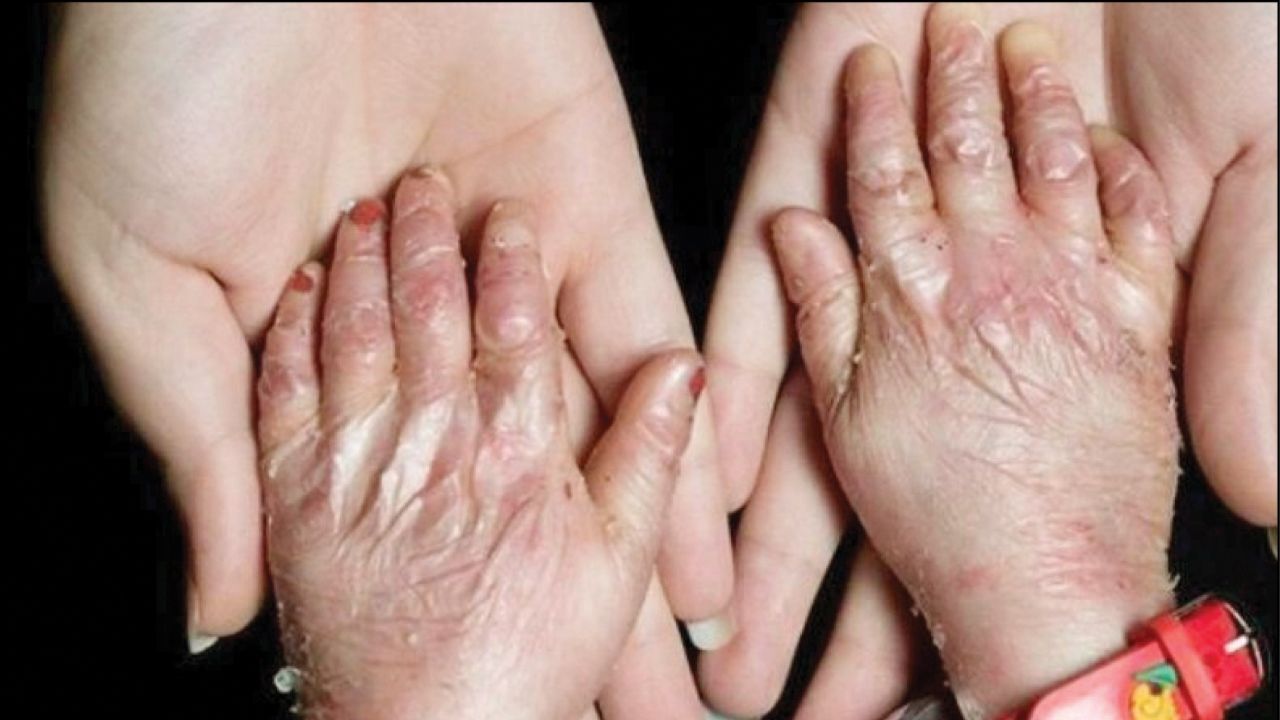 پانسمان‌های بیماران پروانه‌ای کجاست؟