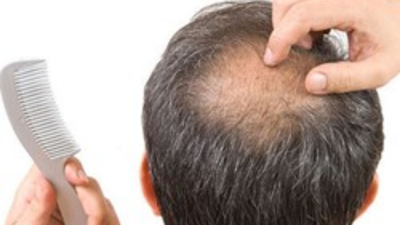 چرا مبتلایان به کرونا دچار ریزش مو می‌شوند؟