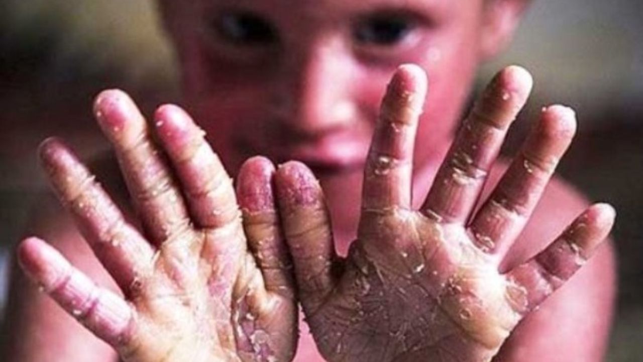 داروهای بیماران ای‌بی رایگان شد