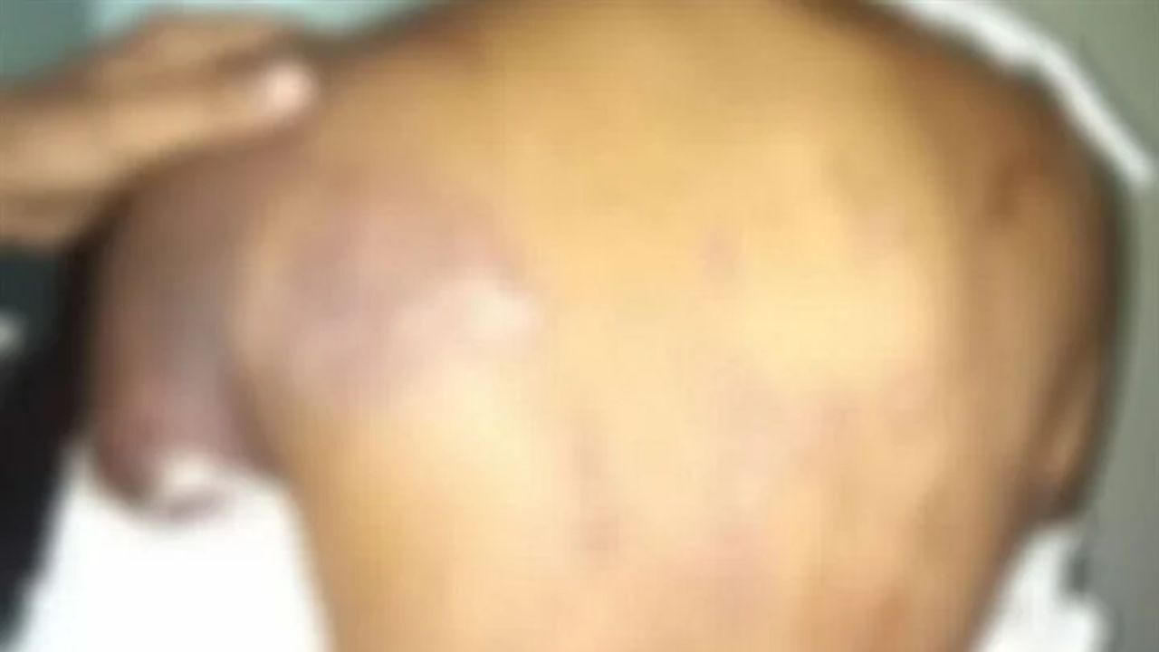 دور دنیا| تتوی اسلامی باعث قطع دست یک جوان هندی شد