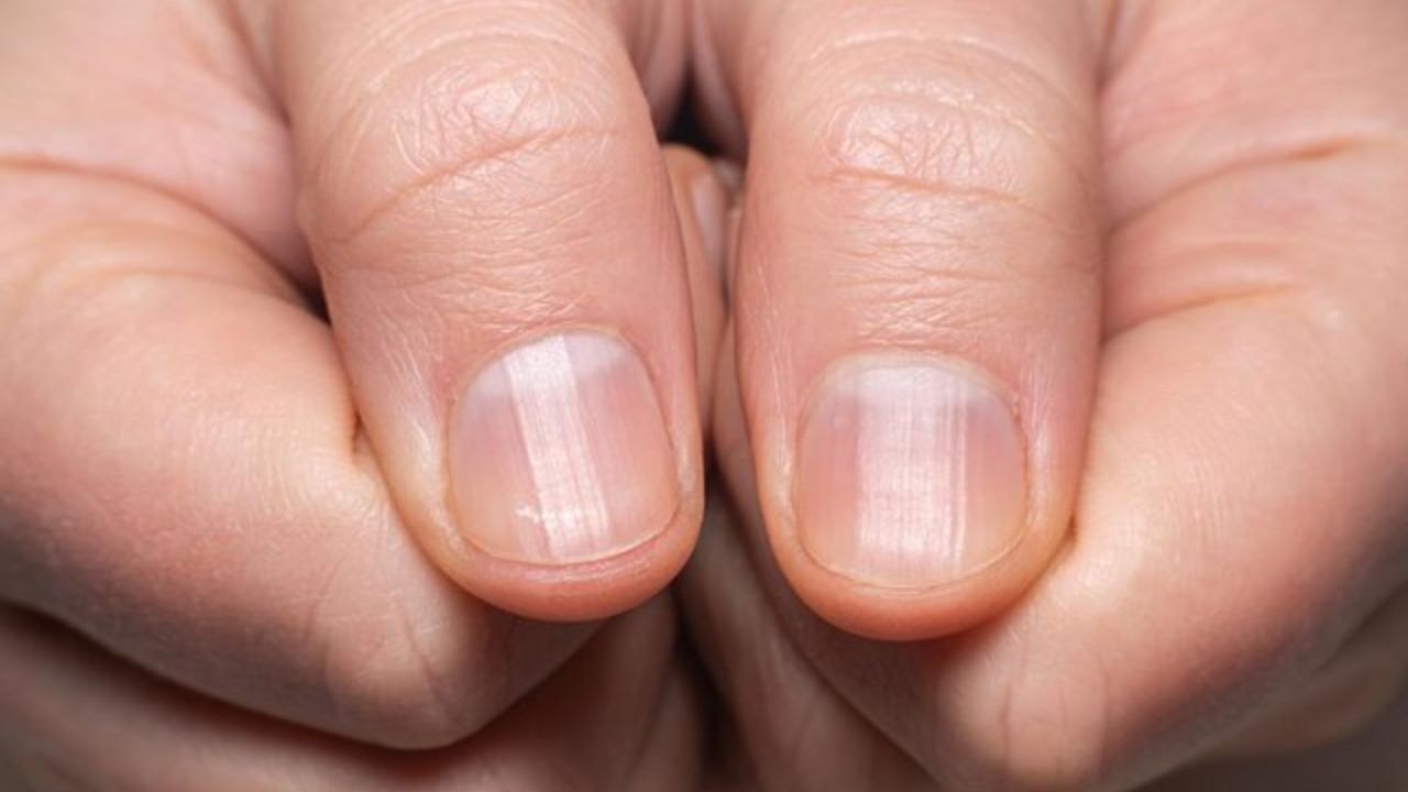 تغییر شکل ناخن نشانه ابتلا به ویروس کروناست؟