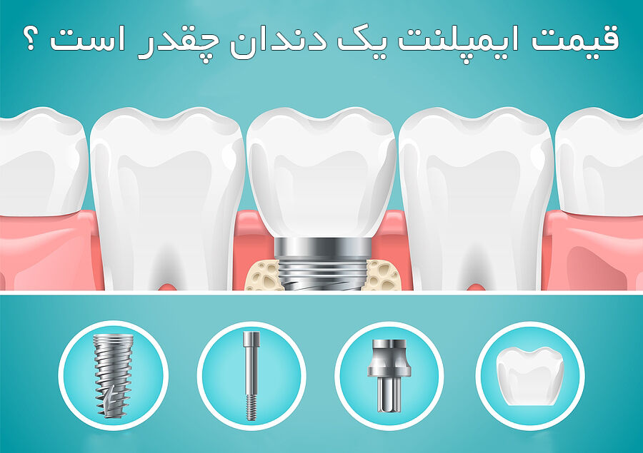 قیمت ایمپلنت یک دندان چقدر است؟